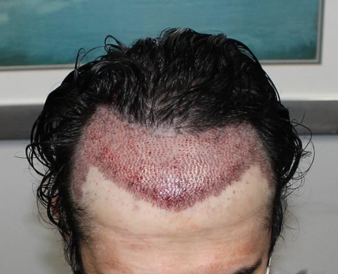 The Process of Hair Transplantation: What To Expect?