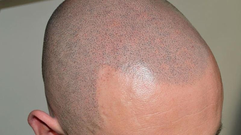 How to Find Affordable Scalp Micropigmentation?