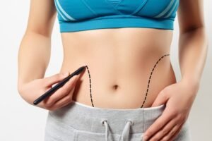 Long-Term Results of Mini Abdominoplasty