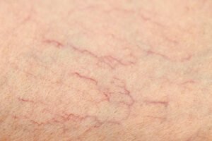 Pain-Free Solutions for Spider Veins 