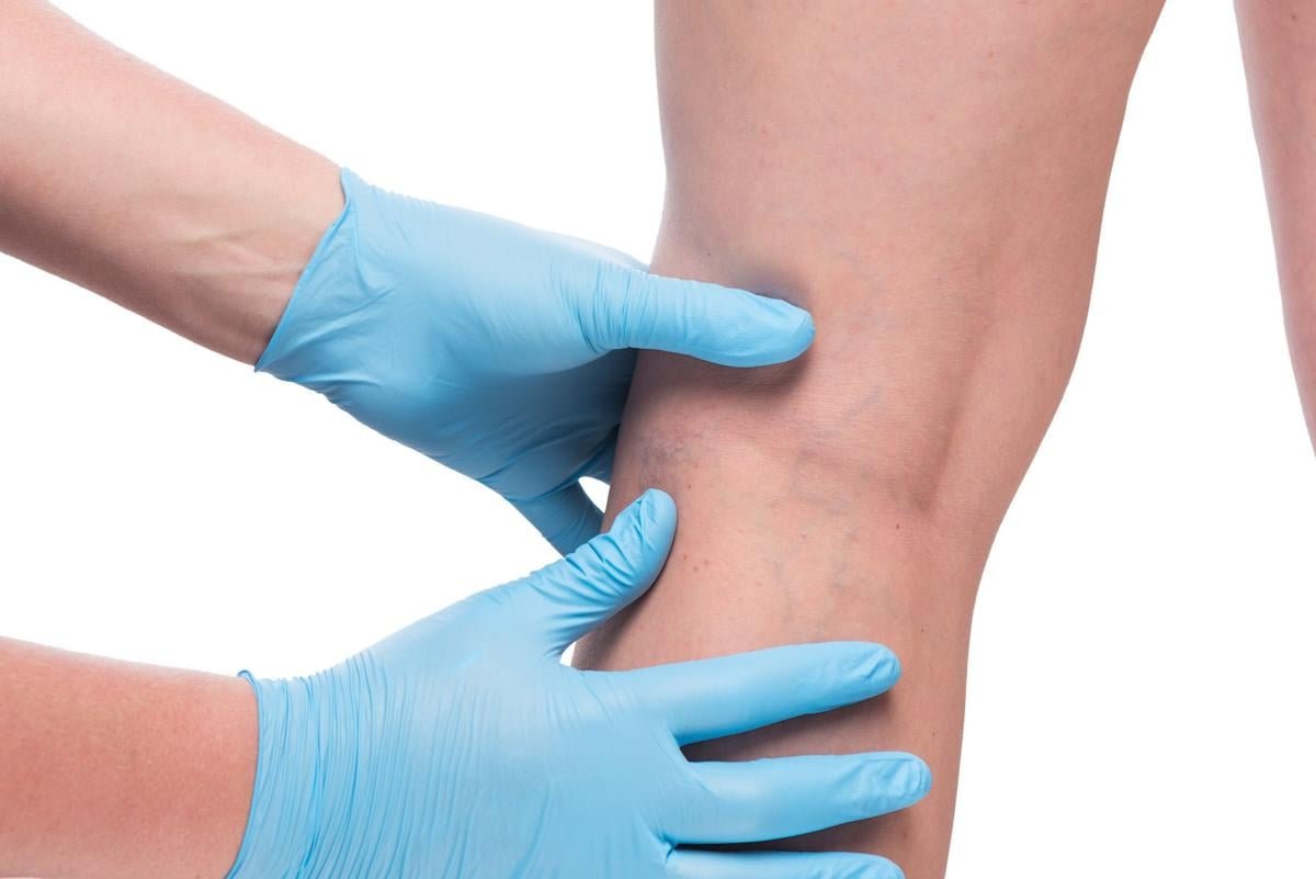 Pain-Free Solutions for Spider Veins