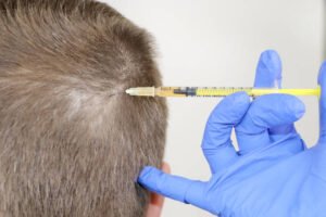 Recovery Tips After PRP Hair Treatment