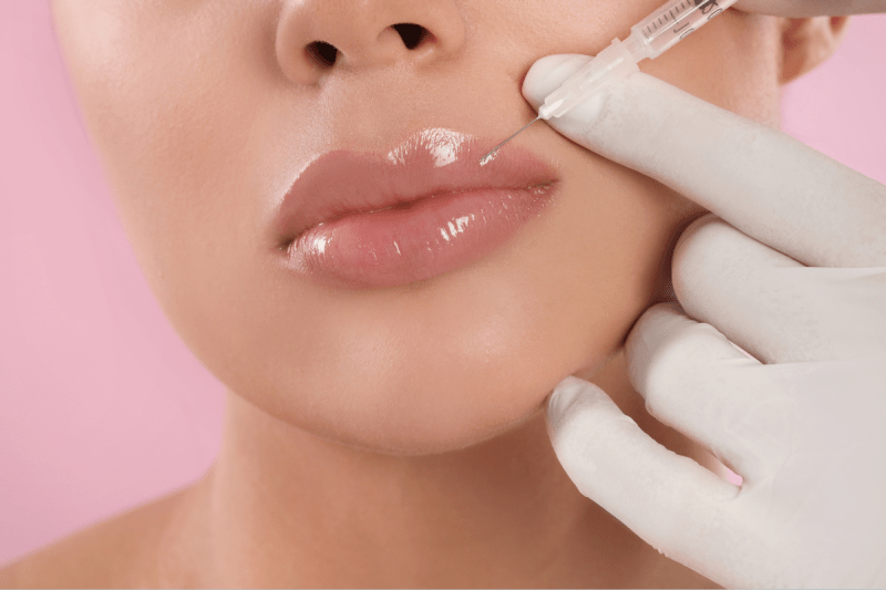 Restore Lip Volume with Fillers