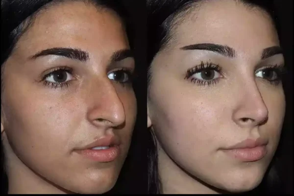 Top Traits of the Best Rhinoplasty Surgeon in Dubai