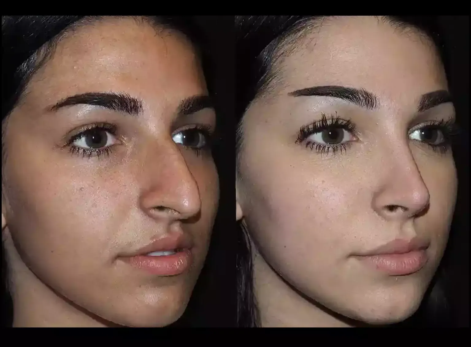 Top Traits of the Best Rhinoplasty Surgeon in Dubai