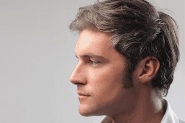 Sideburn Hair Transplant: Get Yours Today!