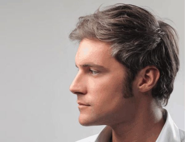 Sideburn Hair Transplant: Get Yours Today!