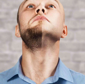 The Benefits of a Beard Hair Transplant