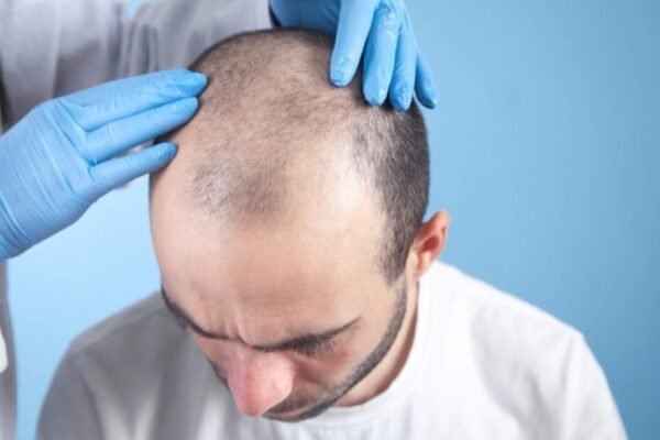 Who Cannot Do a Hair Transplant?