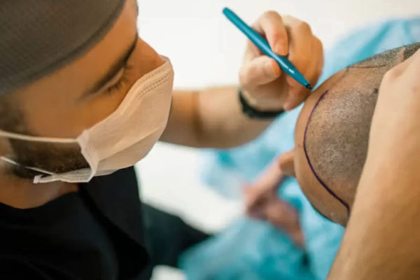 Why Get a Hair Transplant in Summer?