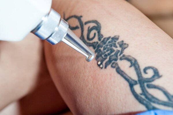 best tattoo removal services