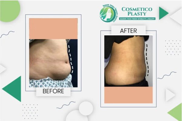 Liposuction Cost in Pakistan