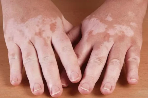 Best Vitiligo Treatment in Delhi