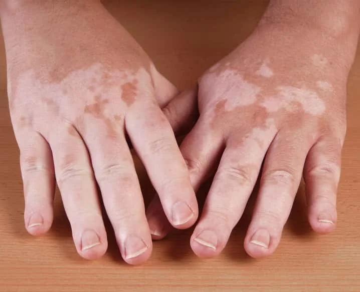 Best Vitiligo Treatment in Delhi