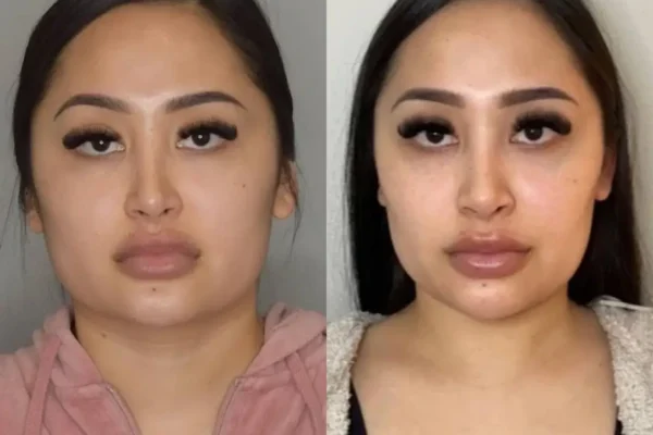 Buccal Fat Removal