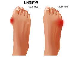 Bunion surgery treatment