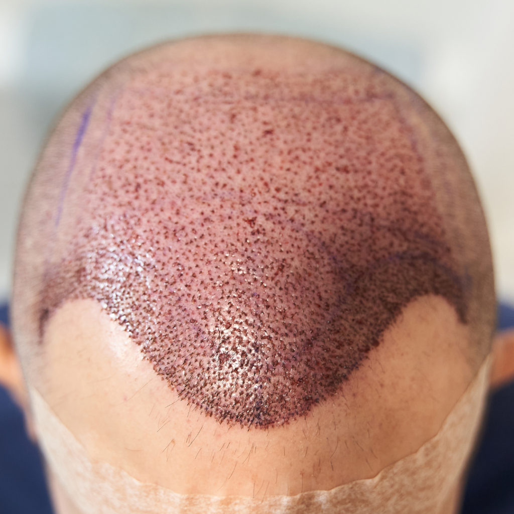 FUE vs. FUT Hair Transplant Which is Best for You