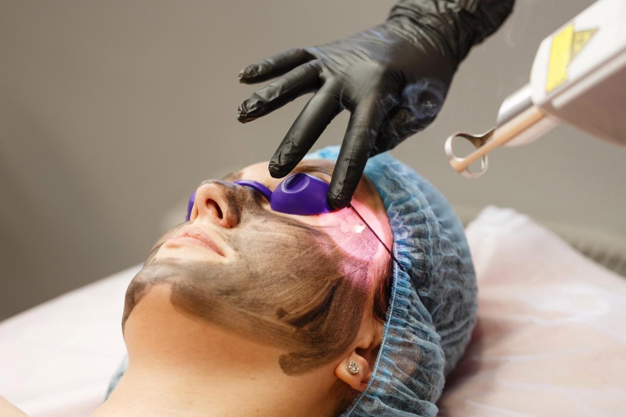 Get a Youthful Glow with Laser Carbon Peel Treatment