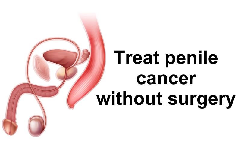 Penile cancer, though relatively rare, is a serious condition that affects the male genital organ. When early signs of penile cancer is highly treatable