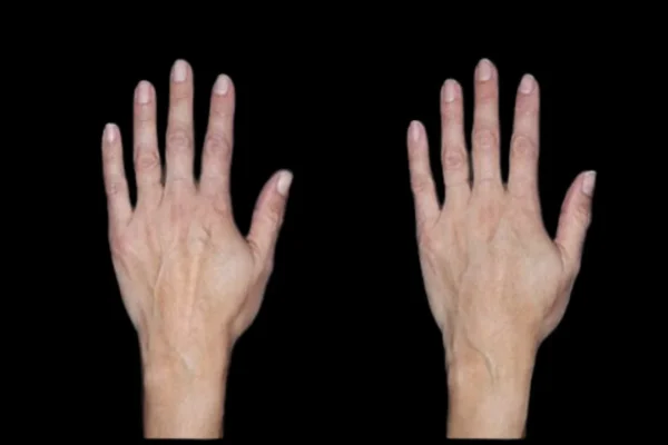 Best Doctors in Dubai for Fat Transfer: Rejuvenate Your Hands Naturally