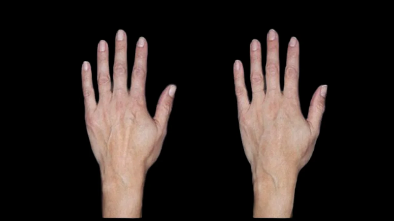 Best Doctors in Dubai for Fat Transfer: Rejuvenate Your Hands Naturally