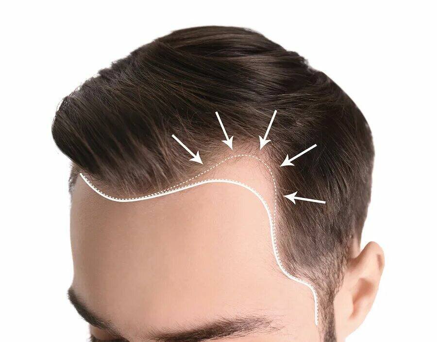 Hair Transplant