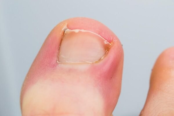 Ingrown Toenails