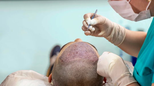 Itching After Hair Transplant: Why It’s Completely Normal