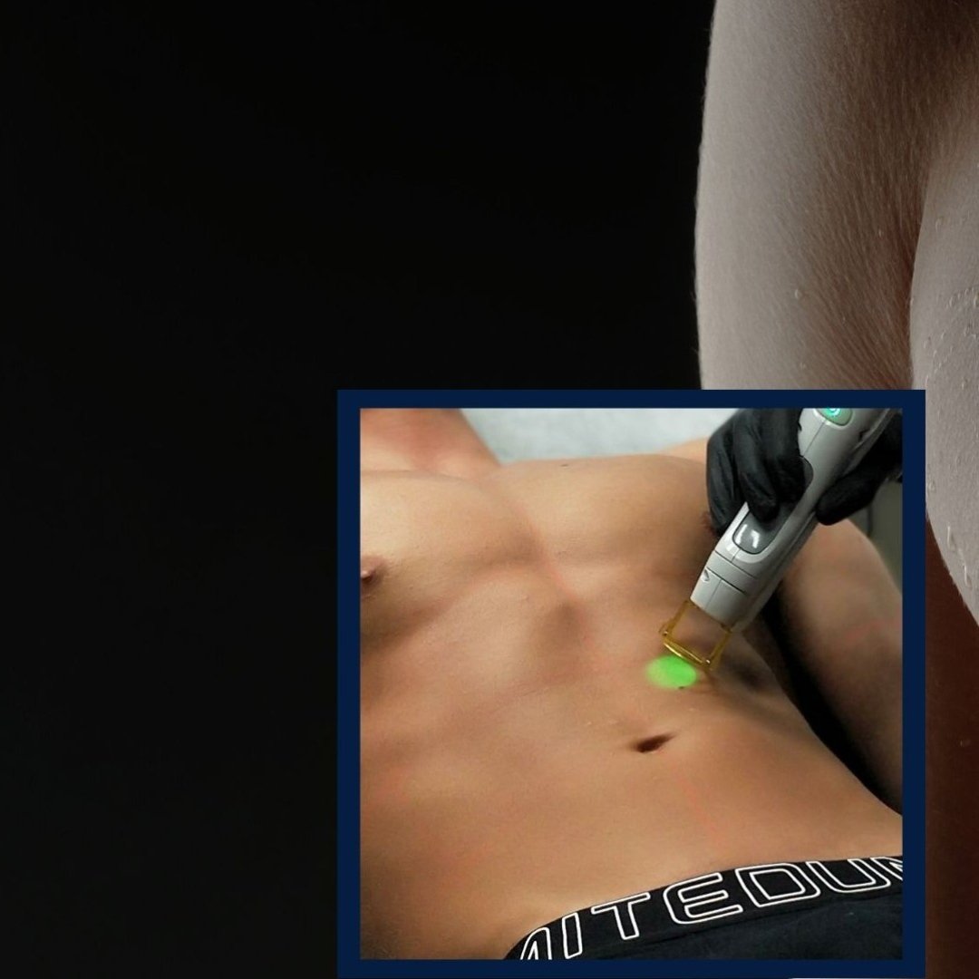 men’s laser hair removal Regents Park