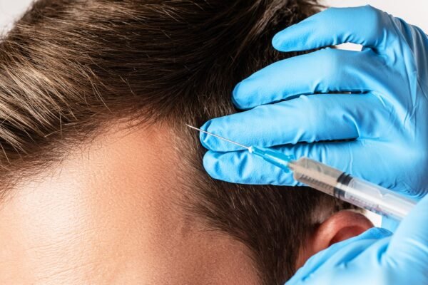 PRP for Hair Loss Treatment Pre and Post Care Instructions