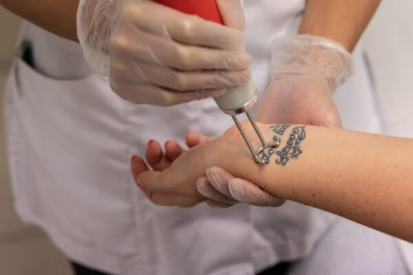 Painless and Scar-Free Tattoo Removal