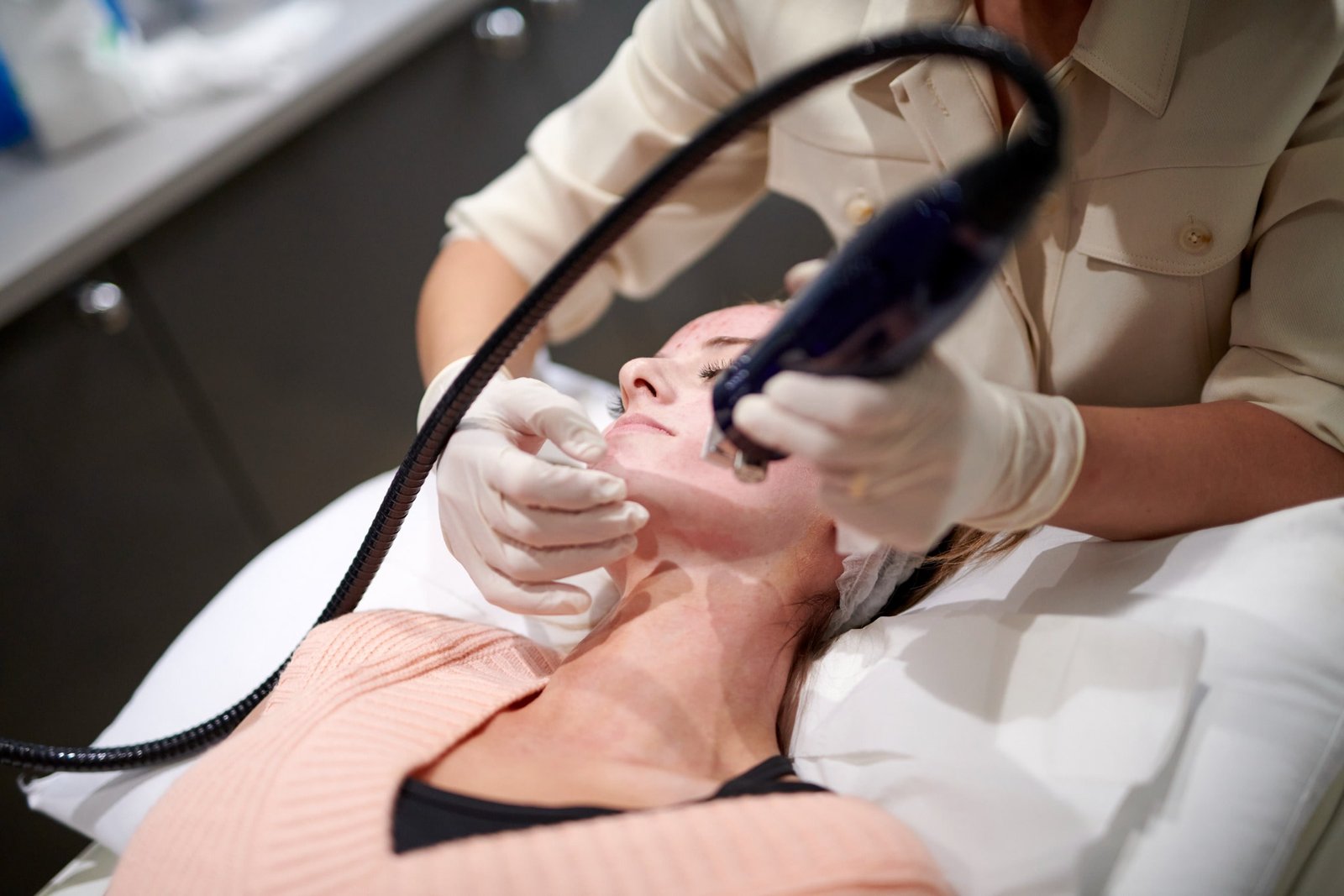 Safe and Effective Laser Treatments for Acne Scars