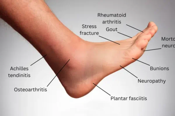 Top foot pain