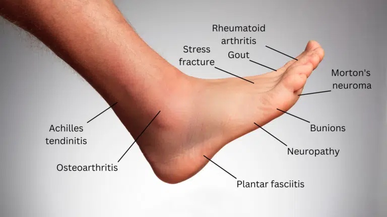 Top foot pain