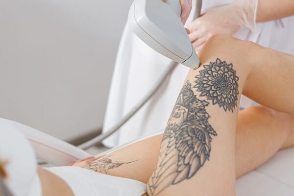 What to Expect After Laser Tattoo Removal