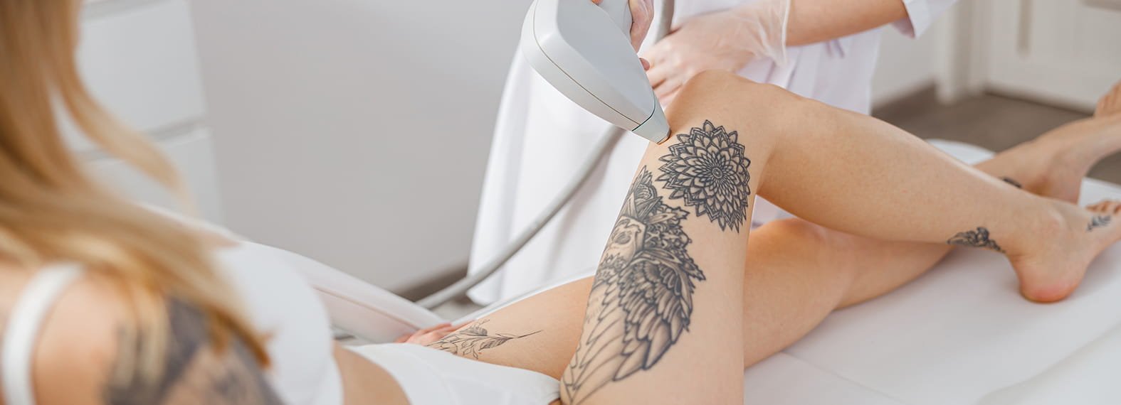 What to Expect After Laser Tattoo Removal