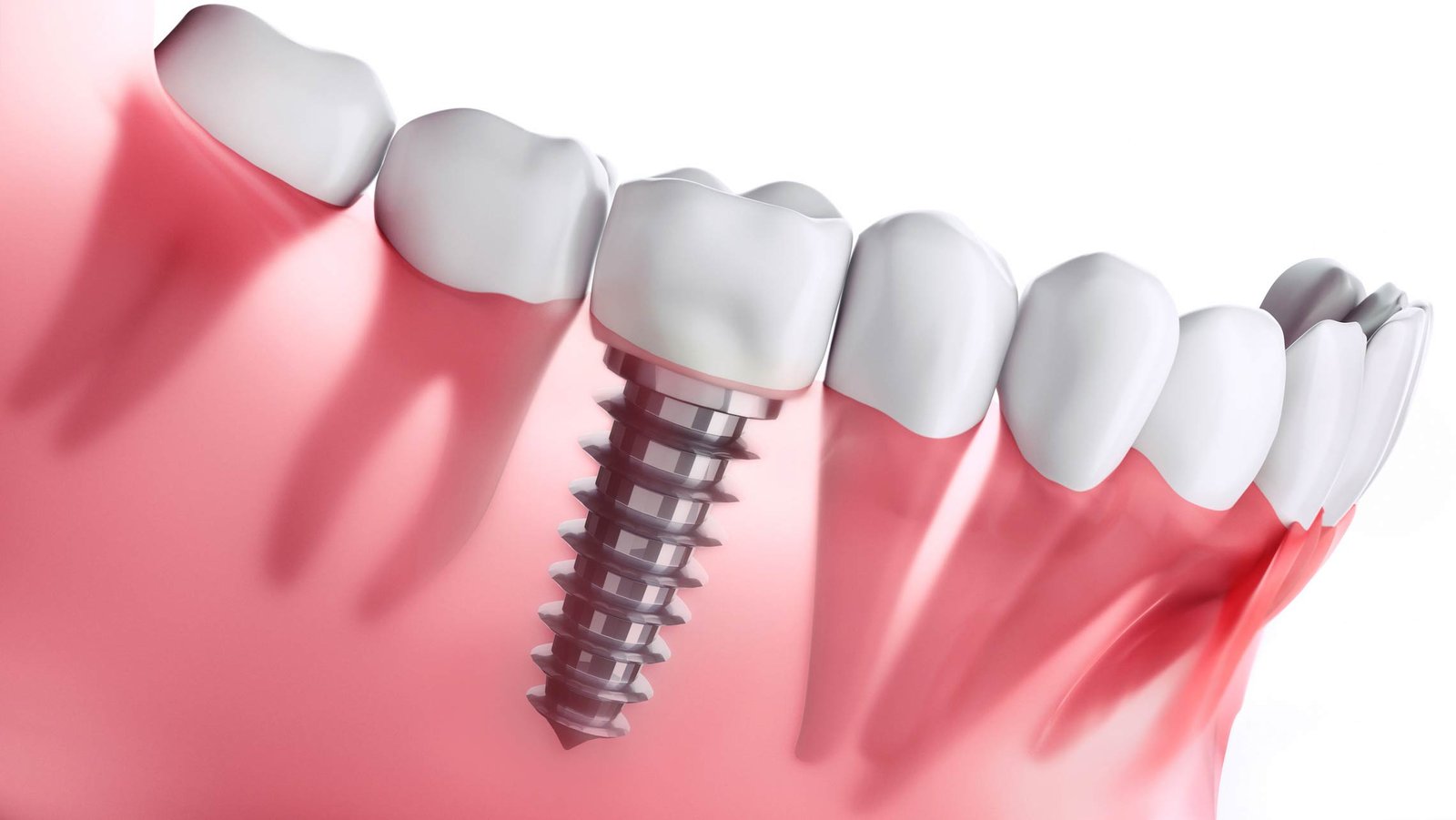 Why Dental Implants Are the Future of Tooth Replacement