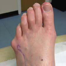 bunion surgery