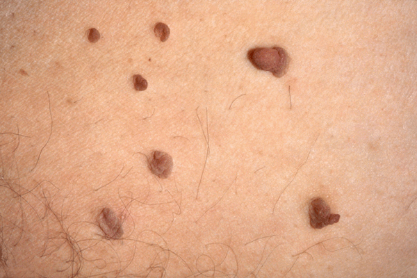 Why do skin tags develop and how to remove them