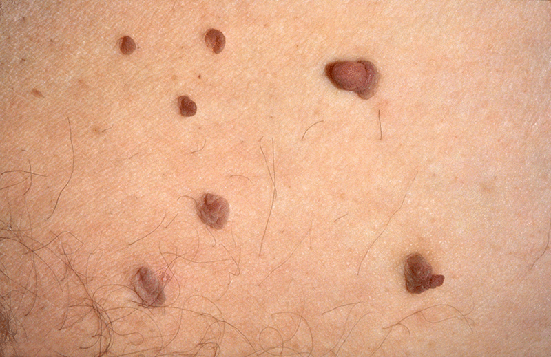 Why do skin tags develop and how to remove them